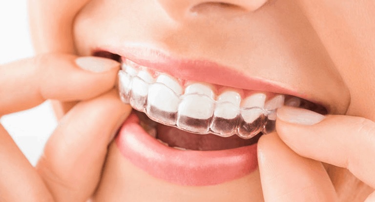 Invisalign Cost on East Patchogue